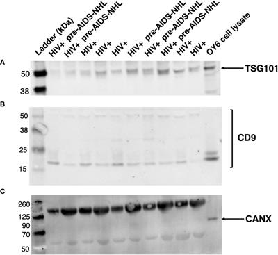 Extracellular vesicles as biomarkers for AIDS-associated non-Hodgkin lymphoma risk